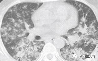 “空气支气管征” 的影像表现与临床意义
