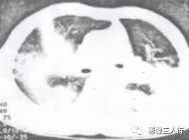 “空气支气管征” 的影像表现与临床意义