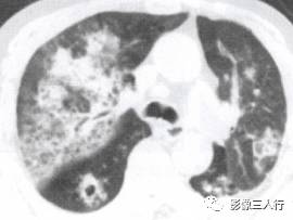 “空气支气管征” 的影像表现与临床意义