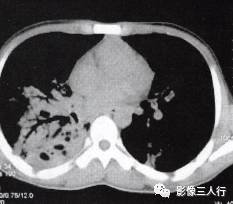 “空气支气管征” 的影像表现与临床意义