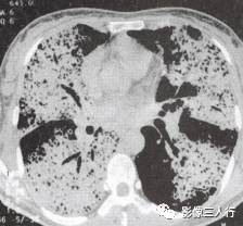 “空气支气管征” 的影像表现与临床意义