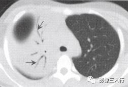 “空气支气管征” 的影像表现与临床意义
