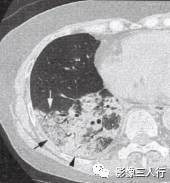 “空气支气管征” 的影像表现与临床意义