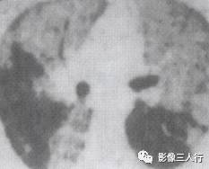 “空气支气管征” 的影像表现与临床意义