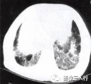 “空气支气管征” 的影像表现与临床意义