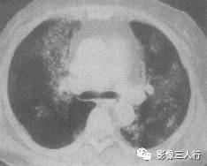 “空气支气管征” 的影像表现与临床意义