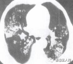 “空气支气管征” 的影像表现与临床意义