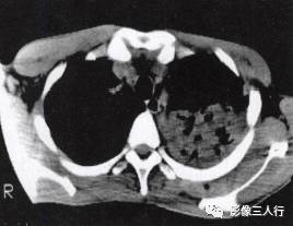 “空气支气管征” 的影像表现与临床意义