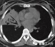 “空气支气管征” 的影像表现与临床意义