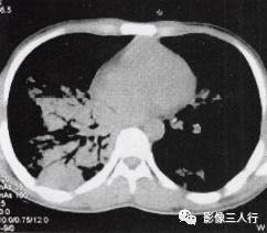 “空气支气管征” 的影像表现与临床意义
