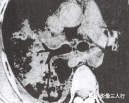 “空气支气管征” 的影像表现与临床意义