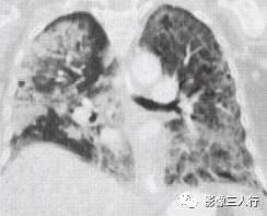 “空气支气管征” 的影像表现与临床意义