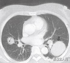 “空气支气管征” 的影像表现与临床意义