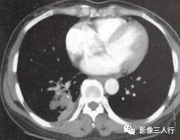 “空气支气管征” 的影像表现与临床意义