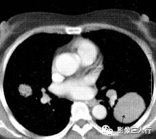 “空气支气管征” 的影像表现与临床意义
