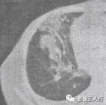 “空气支气管征” 的影像表现与临床意义