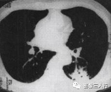 “空气支气管征” 的影像表现与临床意义
