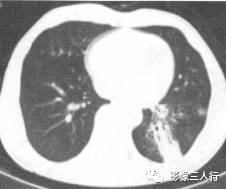 “空气支气管征” 的影像表现与临床意义