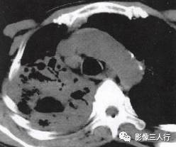 “空气支气管征” 的影像表现与临床意义