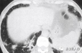“空气支气管征” 的影像表现与临床意义