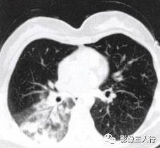 “空气支气管征” 的影像表现与临床意义