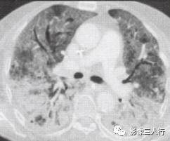 “空气支气管征” 的影像表现与临床意义