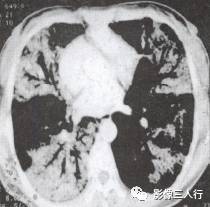 “空气支气管征” 的影像表现与临床意义