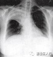 “空气支气管征” 的影像表现与临床意义