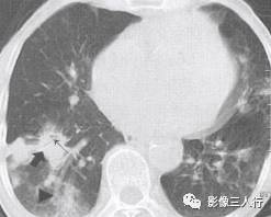 “空气支气管征” 的影像表现与临床意义