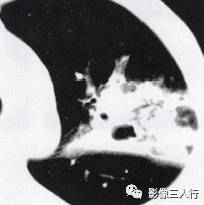 “空气支气管征” 的影像表现与临床意义