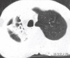 “空气支气管征” 的影像表现与临床意义