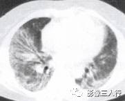 “空气支气管征” 的影像表现与临床意义