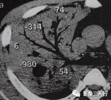 “空气支气管征” 的影像表现与临床意义