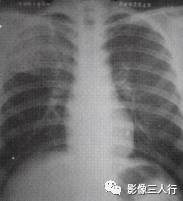 “空气支气管征” 的影像表现与临床意义