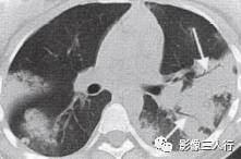 “空气支气管征” 的影像表现与临床意义