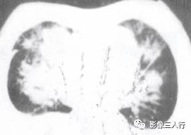 “空气支气管征” 的影像表现与临床意义
