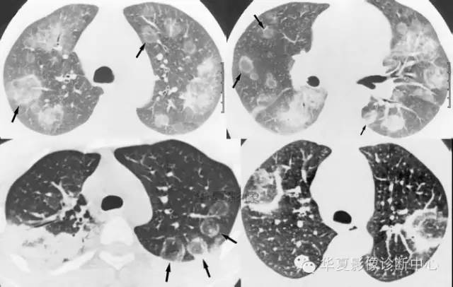 典型影像征象收集