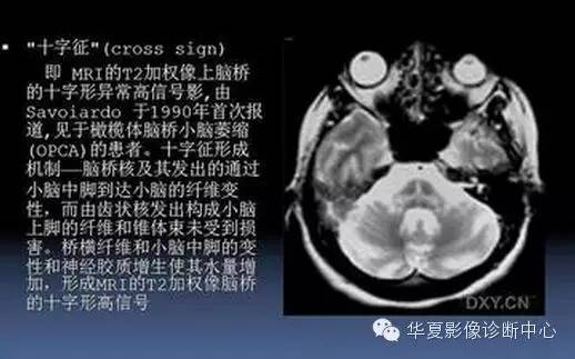 典型影像征象收集