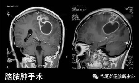 典型影像征象收集 典型影像征象收集