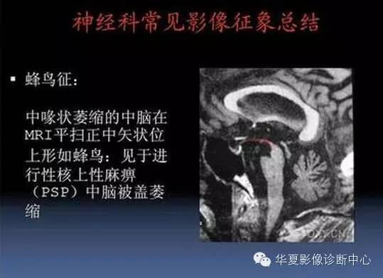 典型影像征象收集 典型影像征象收集