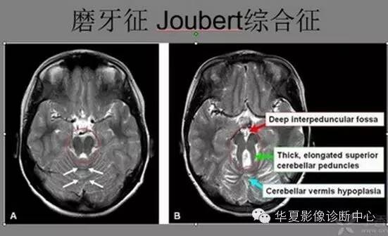 典型影像征象收集