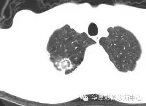 典型影像征象收集