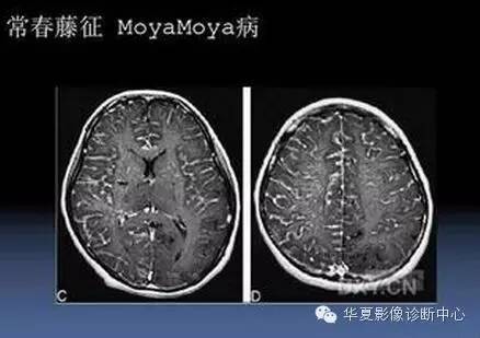 典型影像征象收集