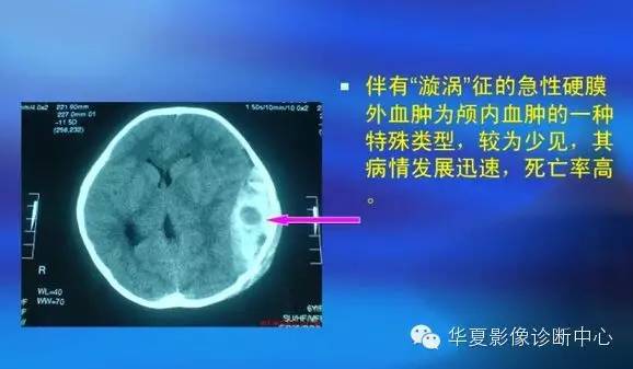 典型影像征象收集 典型影像征象收集