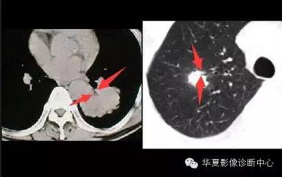 典型影像征象收集