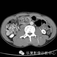 典型影像征象收集 典型影像征象收集