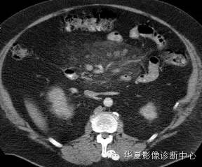 典型影像征象收集