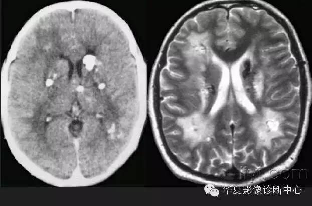 典型影像征象收集