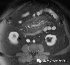 典型影像征象收集 典型影像征象收集