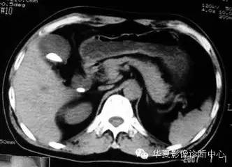 典型影像征象收集